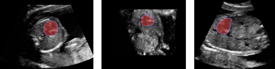 Heart segmentation in a 3D ultrasound image using a pretrained model